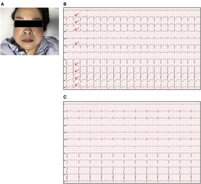 Case report: Unruptured sinus of Valsalva aneurysms causing postural angina pectoris and false “pulmonary hypertension”